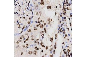 Immunohistochemistry of paraffin-embedded human lung cancer using DiMethyl-Histone H3-K27 antibody. (Histone 3 antibody  (H3K27me))