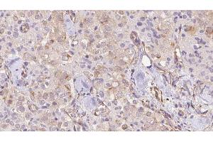 ABIN6273332 at 1/100 staining Human thyroid cancer tissue by IHC-P.