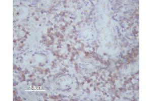 ABIN6266591 at 1/200 staining human Oral squamous cell carcinoma sections by IHC-P. (MMP14 antibody  (C-Term))