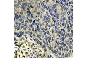 Immunohistochemical analysis of MsrB2 staining in human esophageal cancer formalin fixed paraffin embedded tissue section. (MSRB2 antibody)