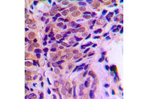 Immunohistochemical analysis of Glucocorticoid Receptor (pS211) staining in human prostate cancer formalin fixed paraffin embedded tissue section. (Glucocorticoid Receptor antibody  (pSer211))