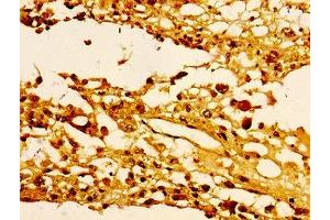 Immunohistochemistry of paraffin-embedded human melanoma using nme1HU at dilution of 1:100