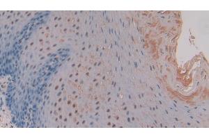 Immunohistochemistry (IHC) image for anti-Matrix Metallopeptidase 11 (Stromelysin 3) (MMP11) (AA 277-488) antibody (ABIN7431380)