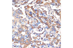Immunohistochemistry of paraffin-embedded human lung cancer using VPS28 Rabbit mAb (ABIN7271275) at dilution of 1:100 (40x lens). (VPS28 antibody)