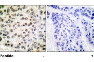 Immunohistochemical analysis of paraffin-embedded human breast carcinoma tissue using POLR2A polyclonal antibody . (POLR2A/RPB1 antibody)