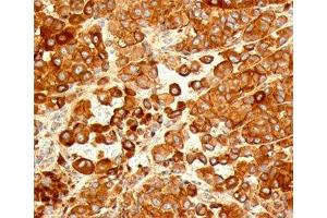 IHC testing of human melanoma stained with CD63 antibody (NKI/C3).