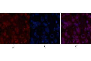 Immunofluorescence analysis of human breast cancer tissue. (POU2F1 antibody)