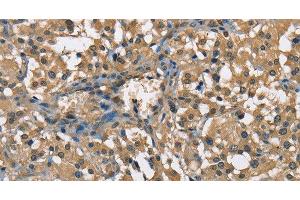 Immunohistochemistry of paraffin-embedded Human thyroid cancer using ENO1 Polyclonal Antibody at dilution of 1:60 (ENO1 antibody)