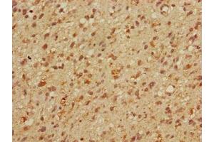 Immunohistochemistry of paraffin-embedded human glioma using ABIN7159613 at dilution of 1:100 (MBD3 antibody  (AA 79-209))