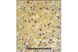 IFT20 Antibody IHC analysis in formalin fixed and paraffin embedded hepatocarcinoma followed by peroxidase conjugation of the secondary antibody and DAB staining.