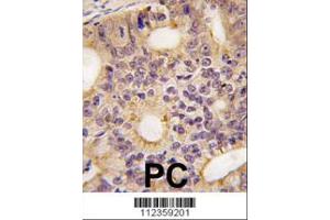 Formalin-fixed and paraffin-embedded human prostata carcinoma tissue reacted with Latexin antibody (N-term), which was peroxidase-conjugated to the secondary antibody, followed by DAB staining. (Latexin antibody  (N-Term))