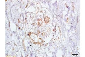 Formalin-fixed and paraffin embedded human breast carcinoma labeled Anti-BRCA2 Polyclonal Antibody, Unconjugated (ABIN673434) at 1:200, followed by conjugation to the secondary antibody and DAB staining