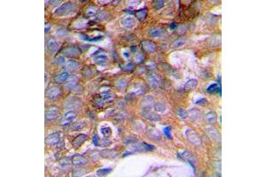 Immunohistochemical analysis of HIBADH staining in human prostate cancer formalin fixed paraffin embedded tissue section. (HIBADH antibody  (C-Term))