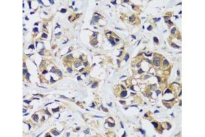 Immunohistochemistry of paraffin-embedded Human breast cancer using CAMLG Polyclonal Antibody at dilution of 1:100 (40x lens). (CAMLG antibody)
