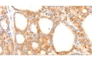 Immunohistochemistry of paraffin-embedded Human thyroid cancer using NAP1L1 Polyclonal Antibody at dilution of 1:70 (NAP1L1 antibody)