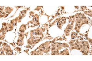 Immunohistochemistry of paraffin-embedded Human breast cancer using ACO2 Polyclonal Antibody at dilution of 1:30 (ACO2 antibody)