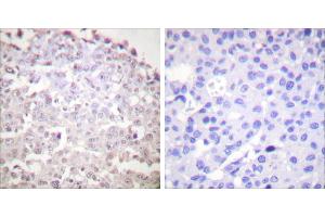 Peptide - +Immunohistochemical analysis of paraffin-embedded human breast carcinoma tissue using GADD153 antibody (#C0202). (DDIT3 antibody)