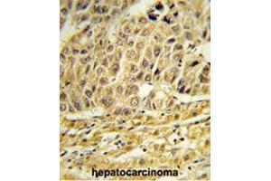 Formalin-fixed and paraffin-embedded human hepatocarcinoma reacted with EED Antibody (Center), which was peroxidase-conjugated to the secondary antibody, followed by DAB staining. (CCNB1IP1 antibody  (C-Term))