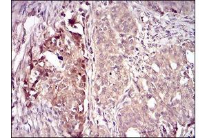 Immunohistochemical analysis of paraffin-embedded cervical cancer tissues using VIL1 mouse mAb with DAB staining.