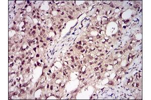 Immunohistochemical analysis of paraffin-embedded cervical cancer tissues using PPP1CB mouse mAb with DAB staining.
