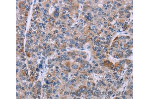 Immunohistochemistry of Human liver cancer using KRT14 Polyclonal Antibody at dilution of 1:20