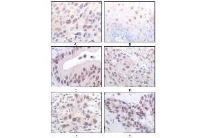 Immunohistochemical analysis of paraffin-embedded human esophageal squamous cell carcinoma (A), normal esophagus epithelium (B), rectum adenocarcinoma (C), lung squamous cell carcinoma (D), breast infiltrating carcinoma (E), and breast infiltrating carcinoma (F) tissues, showing nuclear localization using MOF/MYST1 mouse mAb with DAB staining. (MYST1 antibody)
