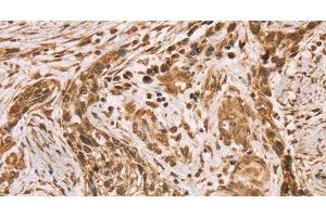 Immunohistochemistry of paraffin-embedded Human esophagus cancer using HIF1AN Polyclonal Antibody at dilution of 1:40 (HIF1AN antibody)