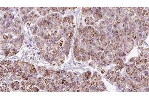 ABIN6273249 at 1/100 staining Human pancreas cancer tissue by IHC-P. (GMFG antibody  (Internal Region))