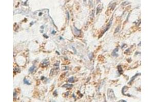 Immunohistochemical analysis of paraffin-embedded human lung carcinoma showing cytoplasmic staining with AARSD1 polyclonal antibody  at a 1 : 100 dilution.