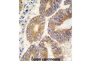 Formalin-fixed and paraffin-embedded human colon carcinomareacted with AHCY polyclonal antibody , which was peroxidase-conjugated to the secondary antibody, followed by AEC staining. (AHCY antibody  (C-Term))