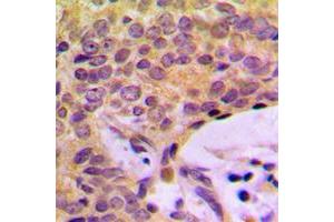 Immunohistochemical analysis of CCP2 staining in human breast cancer formalin fixed paraffin embedded tissue section. (AGBL2 antibody  (C-Term))