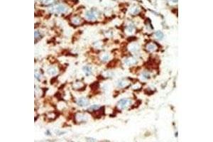 IHC analysis of FFPE human hepatocarcinoma tissue stained with the AMPK beta 1 antibody (PRKAB1 antibody  (AA 4-34))