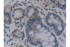 Detection of FGF12 in Human Stomach cancer Tissue using Polyclonal Antibody to Fibroblast Growth Factor 12 (FGF12)