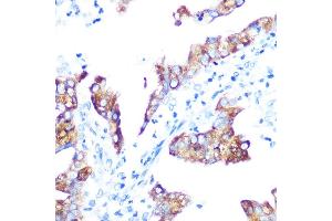Immunohistochemistry of paraffin-embedded human oophoroma using IMP3 Rabbit mAb (ABIN7267904) at dilution of 1:100 (40x lens).