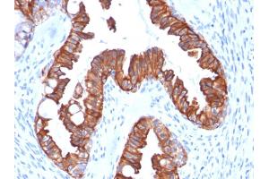 Formalin-fixed, paraffin-embedded human Endometrial Carcinoma stained with CK7 Recombinant Mouse Monoclonal Antibody (rOV-TL12/30). (Recombinant Cytokeratin 7 antibody)