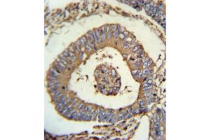 CALR Antibody (ABIN652259 and ABIN2841097) immunohistochemistry analysis in formalin fixed and paraffin embedded human colon carcinoma followed by peroxidase conjugation of the secondary antibody and DAB staining. (Calreticulin antibody)