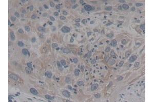 Detection of NTRK3 in Human Lung cancer Tissue using Polyclonal Antibody to Neurotrophic Tyrosine Kinase Receptor Type 3 (NTRK3) (NTRK3 antibody  (AA 32-429))