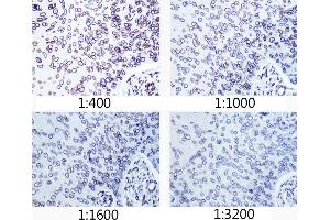 Immunohistochemistry of paraffin-embedded human esophageal cancer using Lamin A/C antibody (ABIN7268177) at dilution of 1:400 - 1:3200 (40x lens). (Lamin A/C antibody)