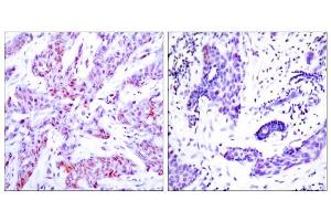 Immunohistochemical analysis of human paraffin-embedded human breast carcinoma tissue using ATF4 (Ab-245) antibody (E021053).