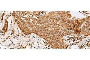 Immunohistochemistry of paraffin-embedded Human esophagus cancer tissue using SAMSN1 Polyclonal Antibody at dilution of 1:80(x200) (SAMSN1 antibody)