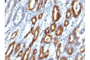 Formalin-fixed, paraffin-embedded human Gastric Carcinoma stained with MUC6 Monoclonal Antibody (MUC6/916). (MUC6 antibody)