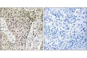 Immunohistochemistry analysis of paraffin-embedded human lung carcinoma, using ARHGEF19 Antibody. (ARHGEF19 antibody  (AA 251-300))