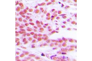 Immunohistochemical analysis of NF-kappaB p65 (pS529) staining in human breast cancer formalin fixed paraffin embedded tissue section. (NF-kB p65 antibody  (C-Term, pSer529))