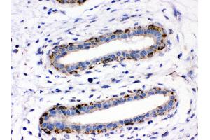 Anti- ASPH Picoband antibody,IHC(P) IHC(P): Human Mammary Cancer Tissue