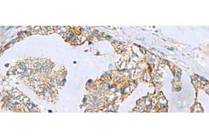 Immunohistochemistry of paraffin-embedded Human gastric cancer tissue using MGME1 Polyclonal Antibody at dilution of 1:70(x200) (C20orf72 antibody)