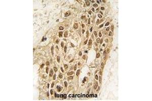 Formalin-fixed and paraffin-embedded human lung carcinoma tissue reacted with Dnmt3a antibody (N-term R46) (ABIN387883 and ABIN2844094) , which was peroxidase-conjugated to the secondary antibody, followed by DAB staining. (DNMT3A antibody  (N-Term))