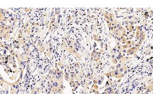 Detection of IL5Ra in Human Lung cancer Tissue using Polyclonal Antibody to Interleukin 5 Receptor Alpha (IL5Ra) (IL5RA antibody  (AA 42-182))