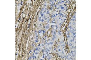 Immunohistochemistry of paraffin-embedded human prostate cancer using COL1A1 antibody. (COL1A1 antibody)