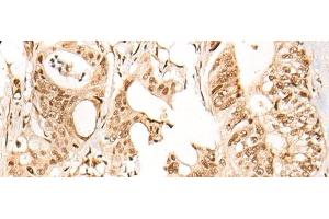 Immunohistochemistry of paraffin-embedded Human colorectal cancer tissue using ARID1B Polyclonal Antibody at dilution of 1:40(x200) (ARID1B antibody)