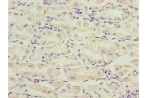 Immunohistochemistry of paraffin-embedded human gastric cancer using ABIN7162519 at dilution of 1:100 (PILRB antibody  (AA 20-191))